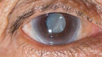 What To Expect When You Have Treatment For Cataracts photo