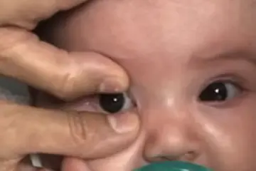 Removing a contact lens from a baby's eye