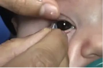 Placing a contact lens on a baby's eye