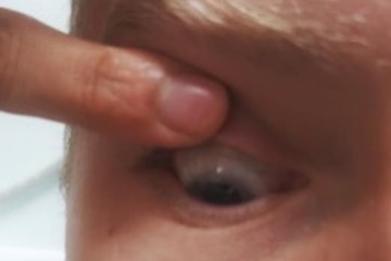 Finger Pressing Eyelid