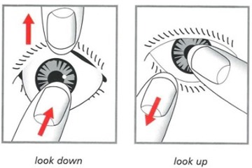 Fitting Prosthetic Eye