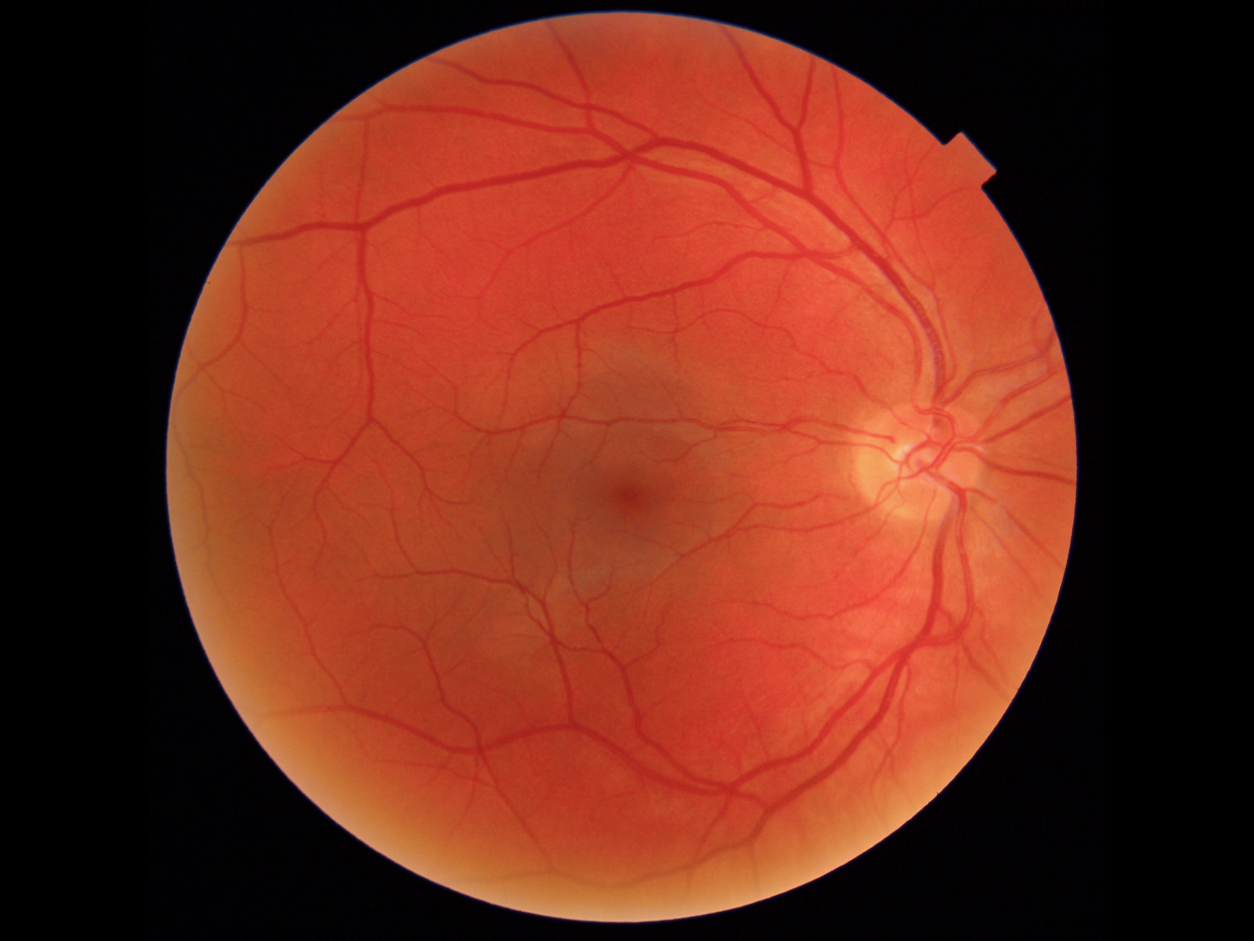 Colour fundus photograph of the retina
