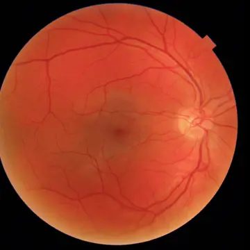 Colour fundus photograph of the retina