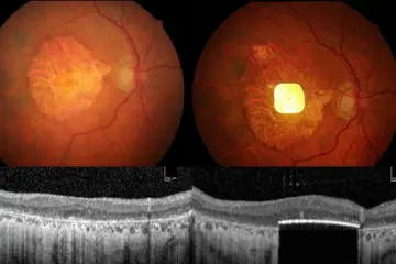 Image showing the implant placed in the eye