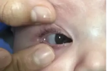 Placing a contact lens on a baby's eye