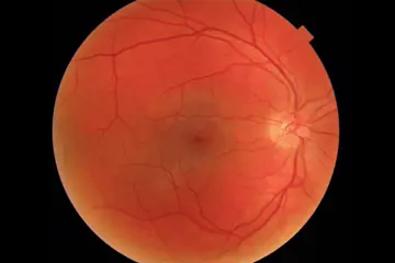 Photo of a Cascader Retinal Image