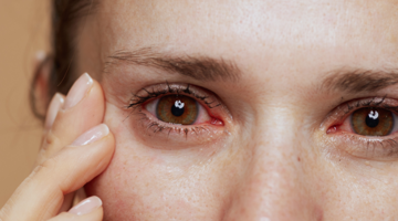 A close up photo of a young woman's face with tired or inflamed eyes