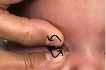 Removing a contact lens from a baby's eye