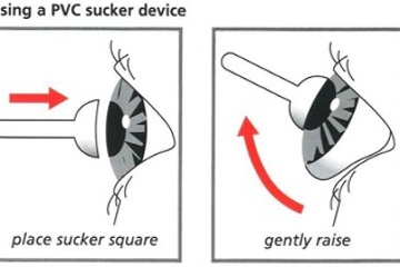 Artificial Eye Sucker Removal