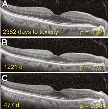 AI Prediction Of HCQ Retinopathy