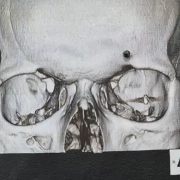 Photo of an X-ray image of bullet